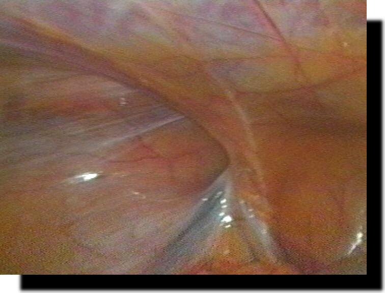 indirekte Leistenhernie